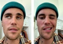 Bieber Fever Gets Serious: What RDHs Should Know about Ramsay-Hunt Syndrome