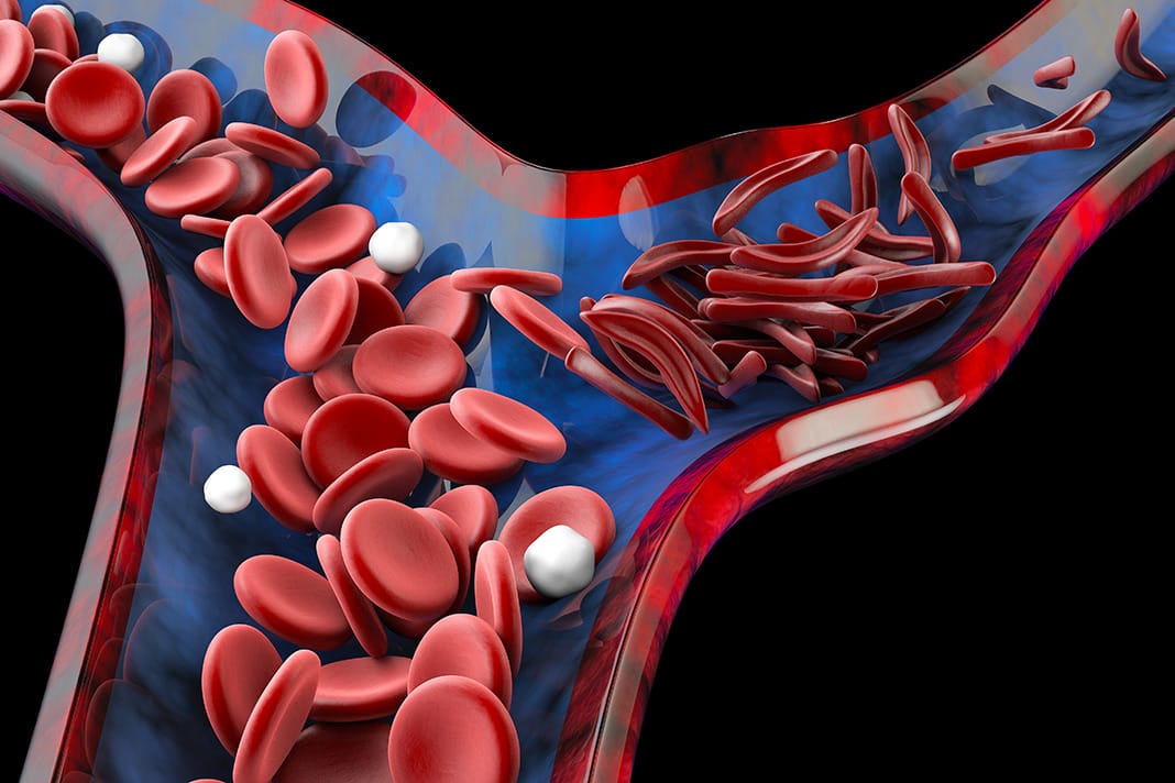 Sickle Cell Disease How Dental Treatment Of Patients Is Influenced Todays Rdh 0489