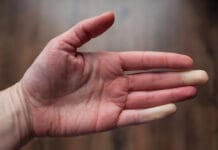 Dental Hygienists at Risk for Developing Hand-Arm Vibration Syndrome