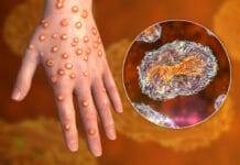 An Overview of Monkeypox for Dental Hygienists & Other Dental Professionals