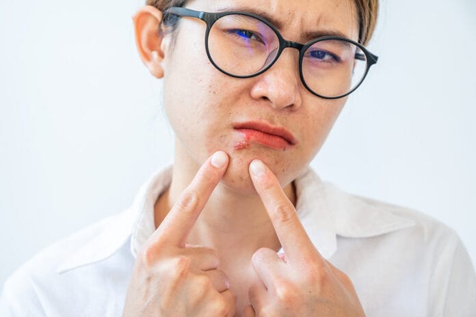 herpes simplex virus