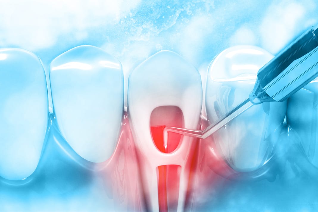 Researchers Look at Tooth Longevity after Root Canal Therapy - Today's RDH