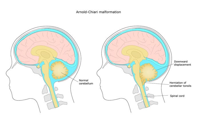 Chiari Malformation: Identifying Potential Oral Health Symptoms in Dental Patients