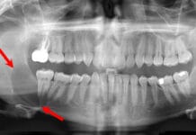 Oral Pathology: Distinguishing Cysts From Abscesses