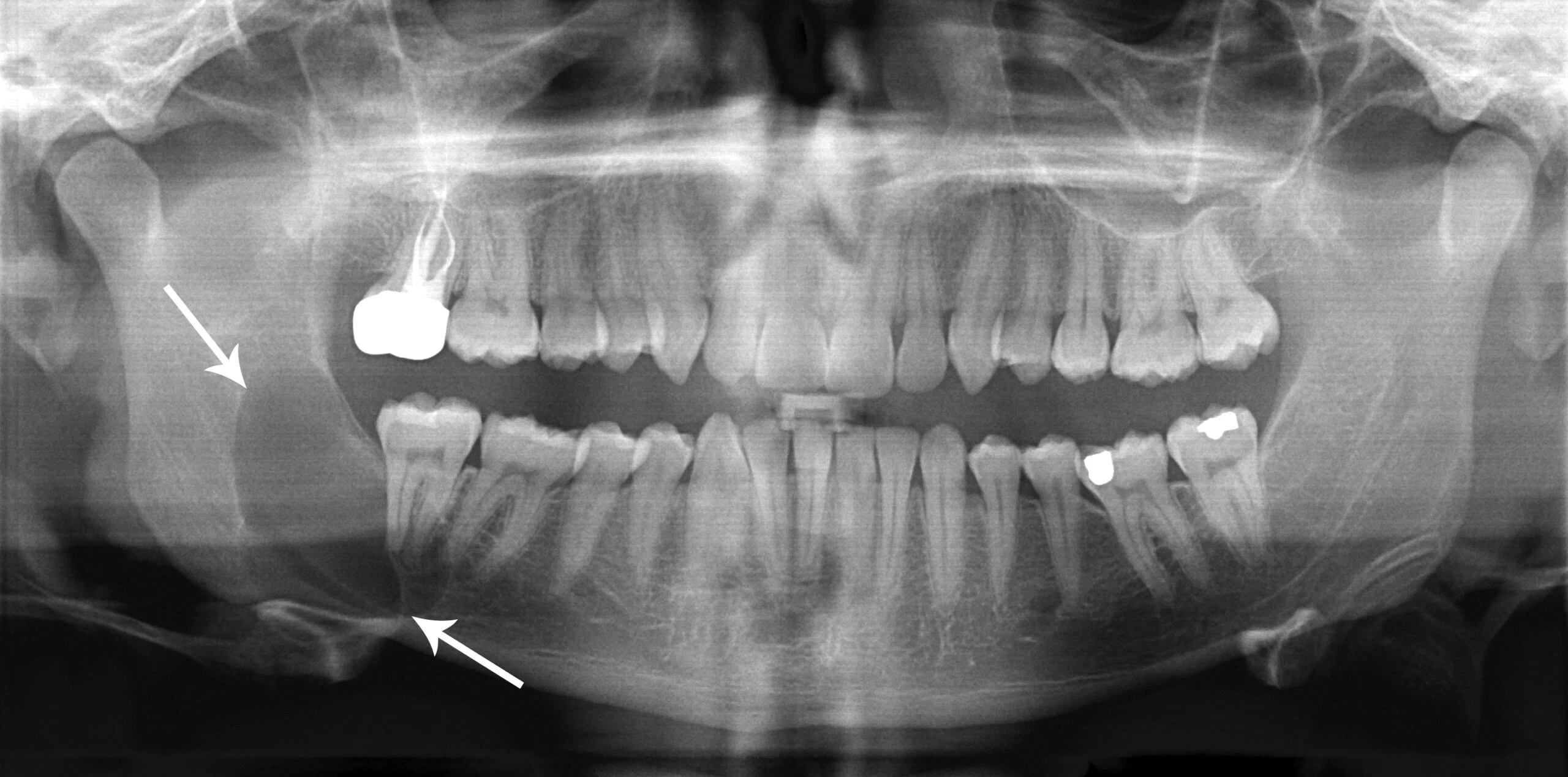 Oral Pathology Distinguishing Cysts from Abscesses Today's RDH