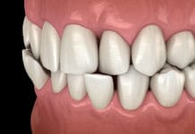 Research History of Traumatic Occlusion and Why More Research is Needed