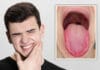 Burning Mouth Syndrome
