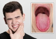 Burning Mouth Syndrome: The Dental Hygienist’s Role in Assessment and Treatment Burning Mouth Syndrome