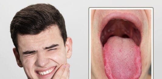 Burning Mouth Syndrome