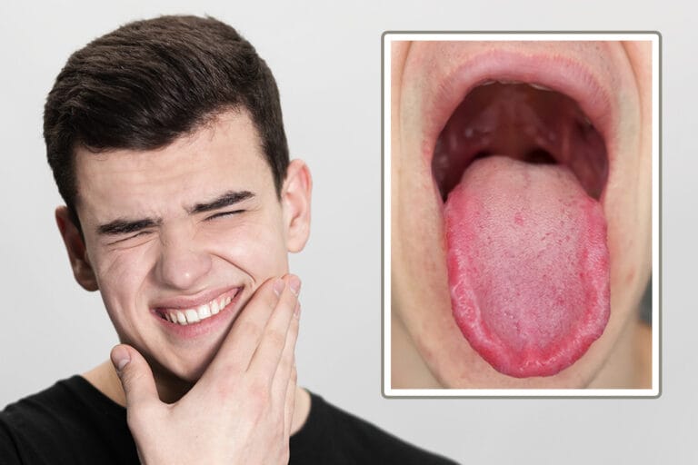 Burning Mouth Syndrome The Dental Hygienist's Role in Assessment and