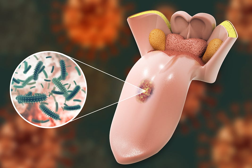 black-spot-mouth-cancer