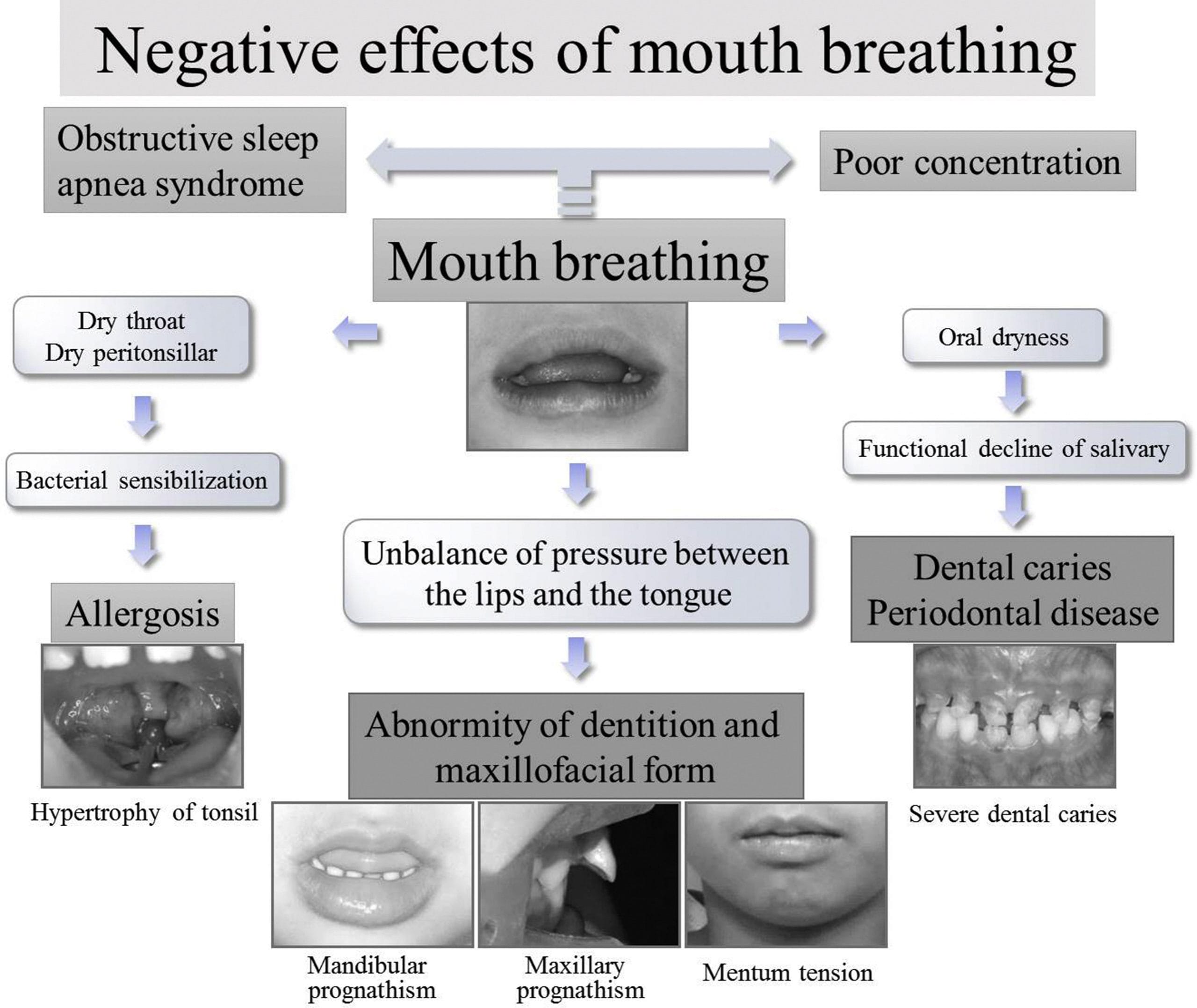 PDF) The Impact of Mouth-Taping in Mouth-Breathers with Mild