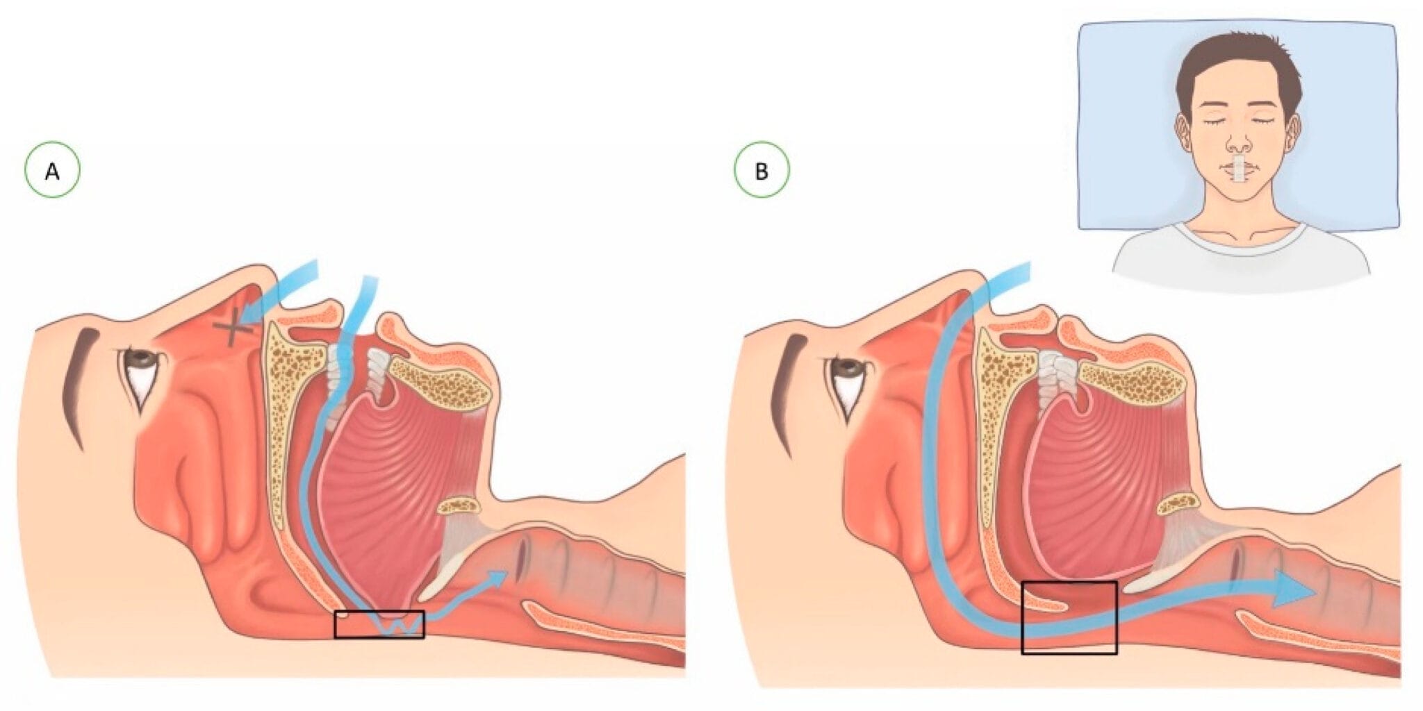 Mouth Taping: Viral Fad or Evidence-Based Treatment for Mouth Breathing ...