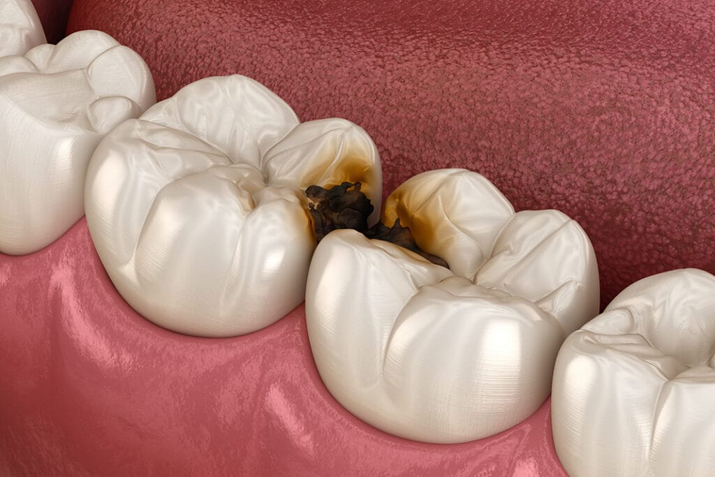 EvidenceBased Dentistry Caries Management Guidelines for the Dental