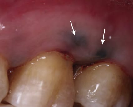 Oral Cavity: Nonneoplastic and Benign Neoplasia | SpringerLink