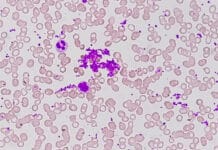 Persistent Gingival Bleeding Despite Excellent Home Care? What Dental Hygienists Should Know About Macrothrombocytopenia