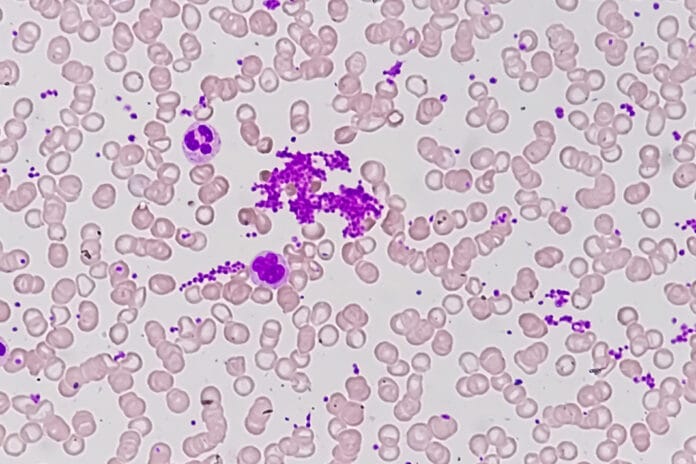 Macrothrombocytopenia