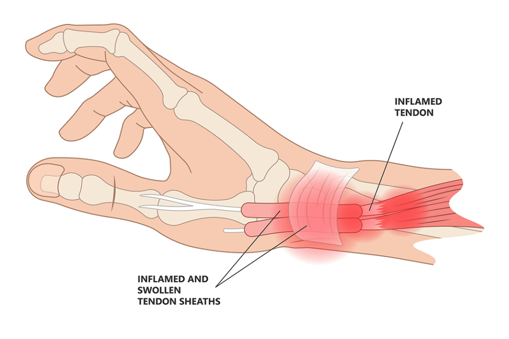 De Quervain’s Tenosynovitis The Painful Part of Practicing Clinical Dental Hygiene Today's RDH