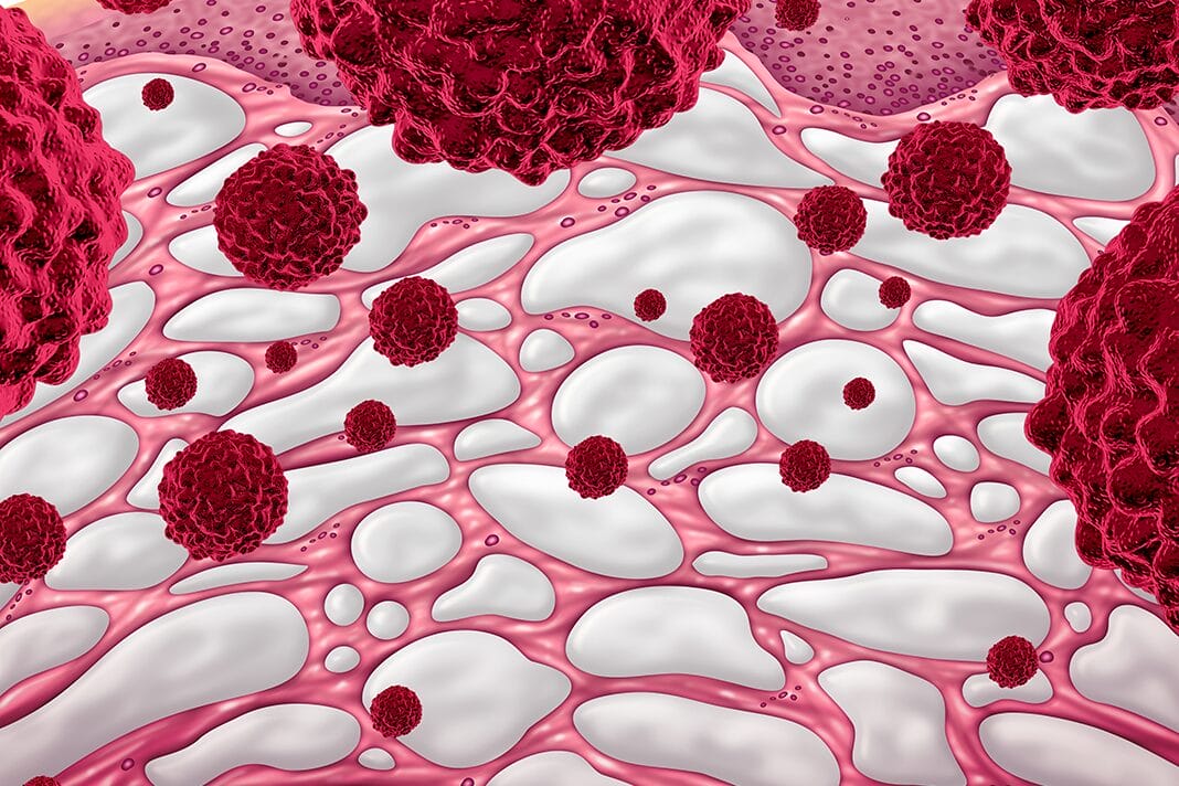The Interstitium: New “Organ” Discovery and Its Potential Influence on ...
