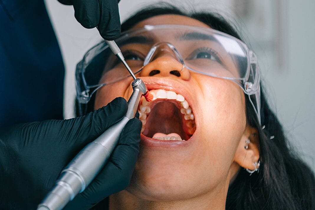 Dental Polishing and Cleansing Agents A Quick Guide to Coronal