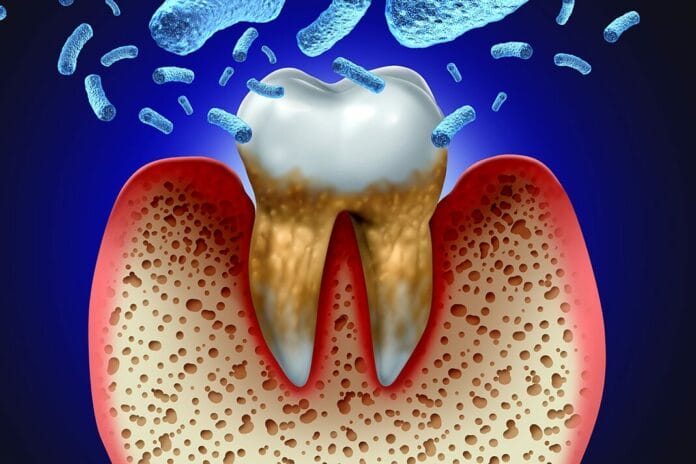 Researchers Identify New Phenotype and Inflammatory Responses Triggered by Oral Biofilm