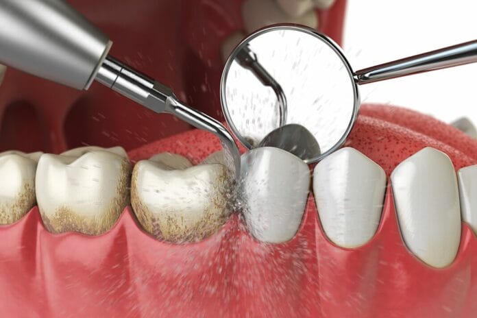 QUIZ: Test Your Ultrasonic Instrumentation Knowledge