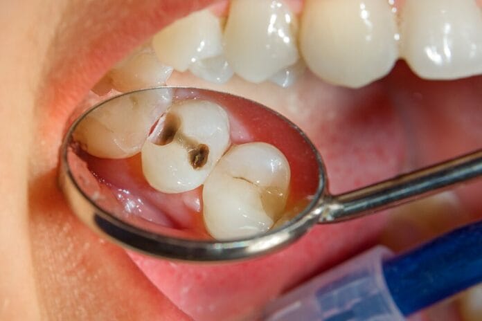 Systematic Review Summarizes the Evidence on the Association Between Periodontitis and Dental Caries