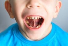 Early Childhood Caries Research: Using Silver Diamine Fluoride in Combination with Fluoride Varnish