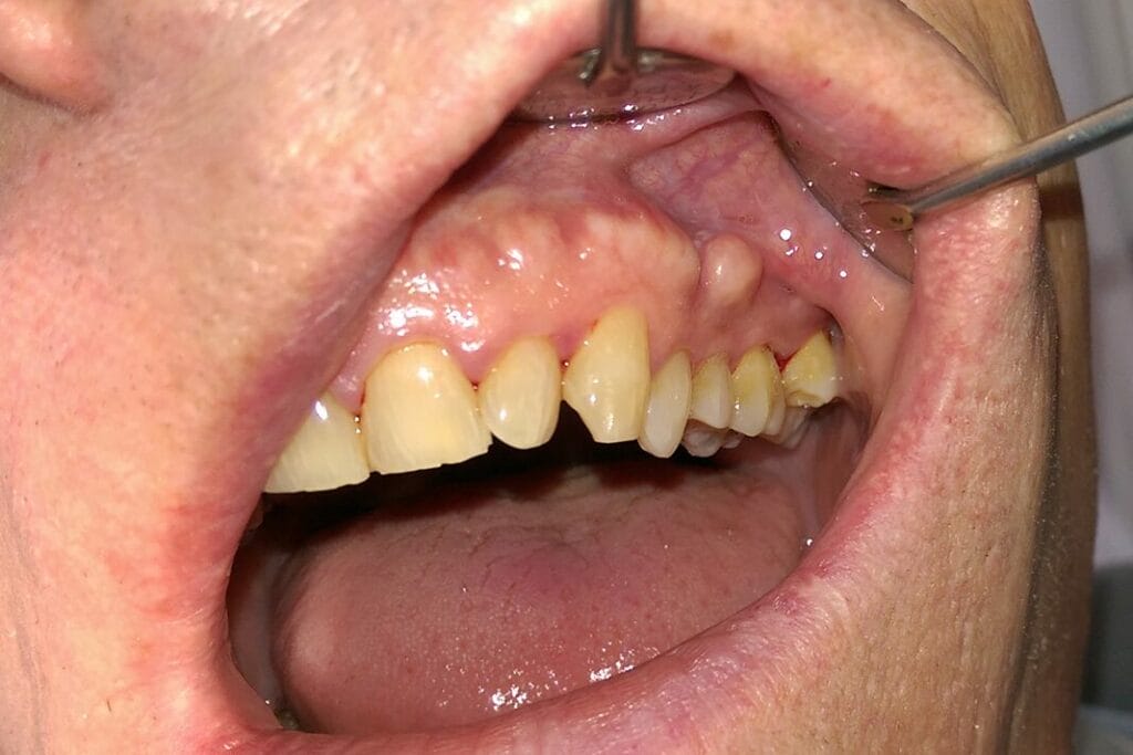 Tori and Exostoses: A Hygienists’ Review and Removal Methods - Today's RDH