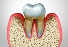 Researchers Investigate the Impact of Periodontitis and Systemic Inflammation with Mortality Risk