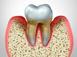 Researchers Investigate the Impact of Periodontitis and Systemic Inflammation with Mortality Risk