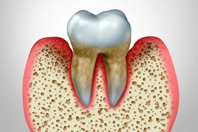 Researchers Investigate the Impact of Periodontitis and Systemic Inflammation with Mortality Risk