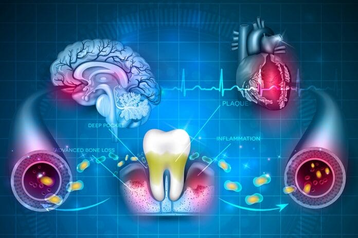 stroke and periodontitis