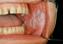 QUIZ: Test Your Oral White Lesions Knowledge