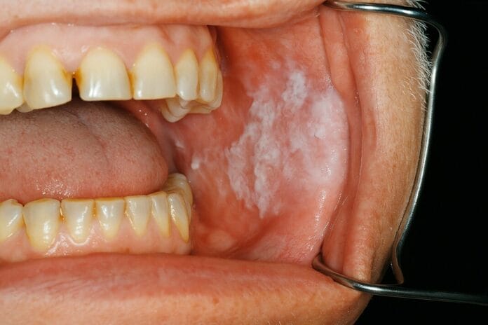 oral leukokeratosis