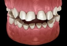QUIZ: Test Your Bruxism Knowledge