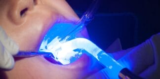 Researchers Compare Silver Diamine Fluoride vs Sealants for Community-Based Dental Caries Prevention