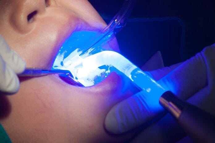 Researchers Compare Silver Diamine Fluoride vs Sealants for Community-Based Dental Caries Prevention