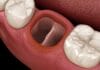QUIZ: Test Your Dry Socket Knowledge